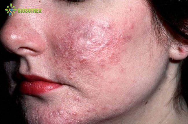 Cách trị mụn bọc nhanh nhất không để lại thâm sẹo