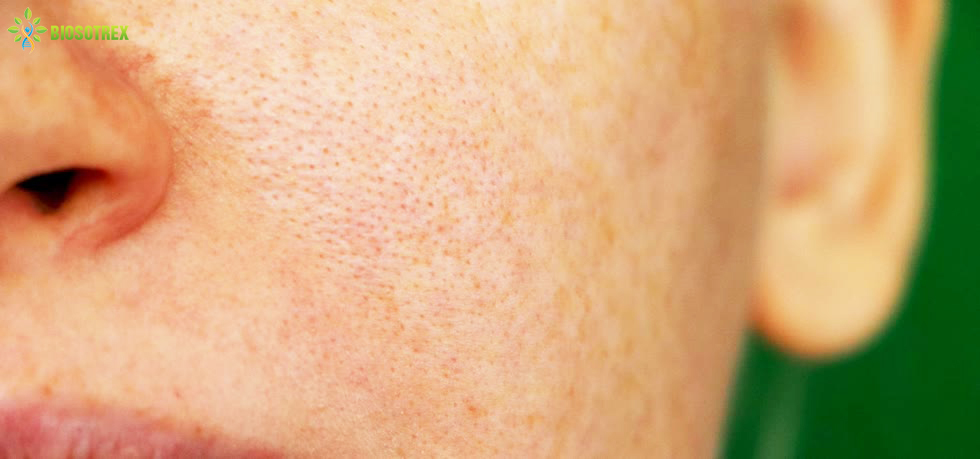Tại sao chăm sóc da cẩn thận nhưng mụn vẫn ghé thăm thường xuyên?