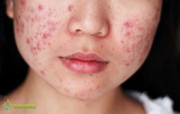 GIẢI MÃ 6 VỊ TRÍ MỤN THƯỜNG XUẤT HIỆN Ở MẶT VÀ LỜI KHUYÊN CỦA CÁC CHUYÊN GIA