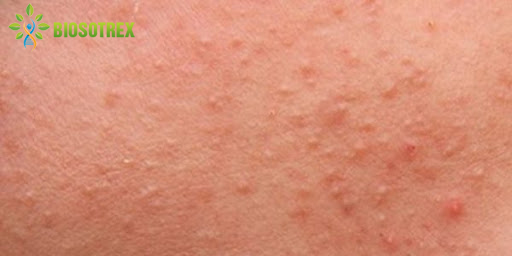 Nhận Diện 6 Loại Mụn Thường Gặp Nhất Ở Da