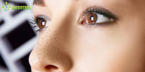 Nhận Diện 6 Loại Mụn Thường Gặp Nhất Ở Da