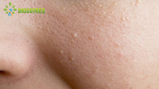 Nhận Diện 6 Loại Mụn Thường Gặp Nhất Ở Da