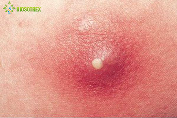 Nhận Diện 6 Loại Mụn Thường Gặp Nhất Ở Dav