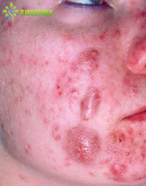 Nhận Diện 6 Loại Mụn Thường Gặp Nhất Ở Dav