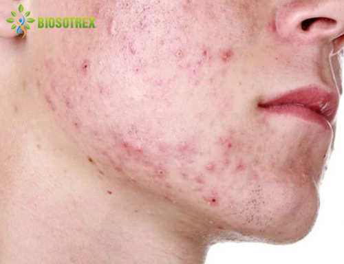 Nhận Diện 6 Loại Mụn Thường Gặp Nhất Ở Da