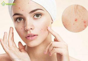 Tại sao chăm sóc da cẩn thận nhưng mụn vẫn ghé thăm thường xuyên?