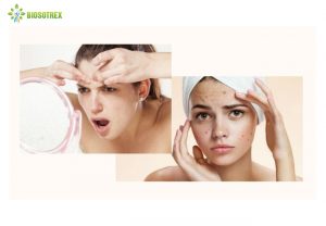 [CẢNH BÁO]Hậu quả khôn lường từ mụn gây nên. Đâu là giải pháp điều trị mụn hiệu quả?