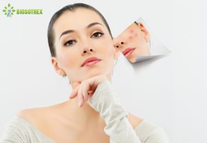 Nguyên nhân phổ biến gây mụn cám và cách xử lý hiệu quả